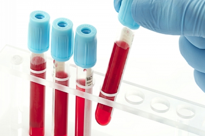 درمان کرونا با کمک سلول های بنیادی خون قاعدگی