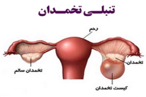 تنبلی تخمدان شایع‌ ترین بیماری غدد درون‌ ریز خانم‌های جوان